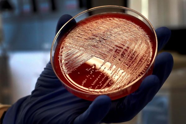 Síntomas, Causas y Prevención de la Listeriosis